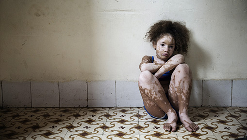 Rosa Mariniello - Vitiligo Rosa Mariniello - Vitiligo