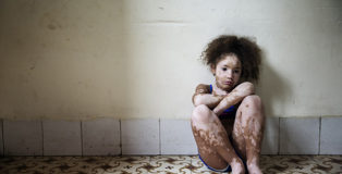 Rosa Mariniello - Vitiligo